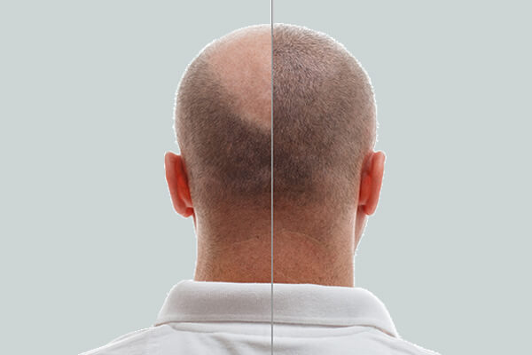 What Happens in PRP & PRF Hair Restoration Treatment Procedure?