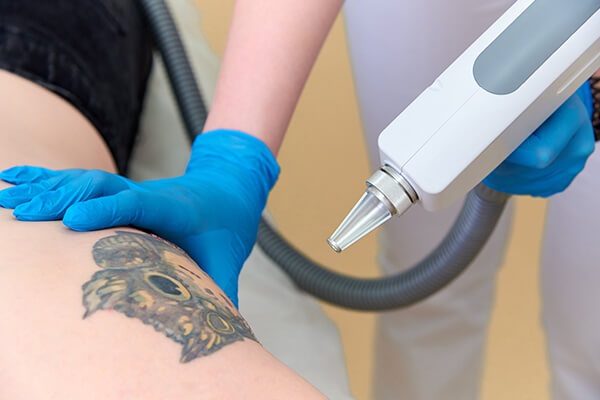 How Long Does It Take to Perform Laser Tattoo Removal?
