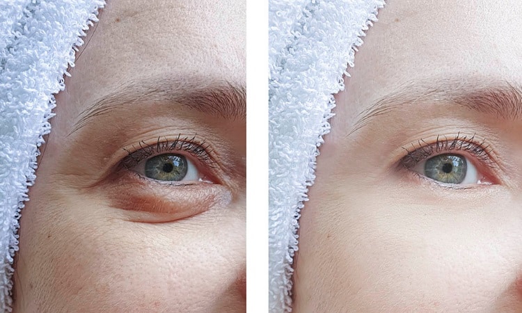 How Long Do Non-Surgical Blepharoplasty Results Last