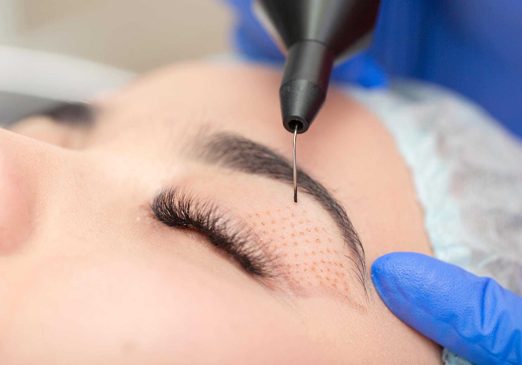 non-surgical blepharoplasty