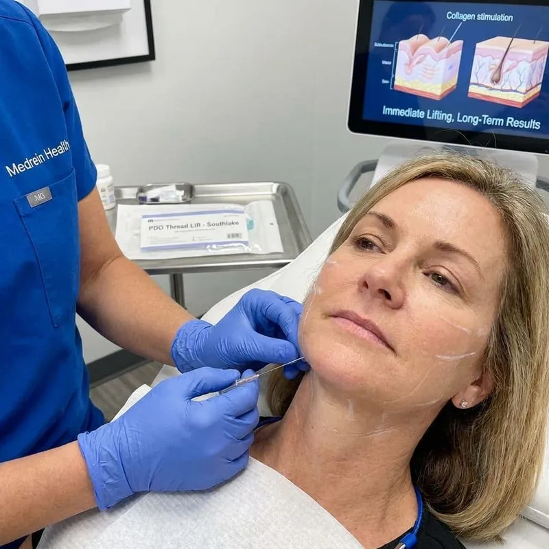 7 Best PDO Thread Lift Benefits for Non-Surgical Face and Neck Tightening