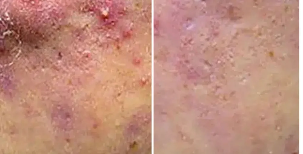 Active Acne Treatment before and after, enlarged: the same person before treatment on the left and after treatment on the right, case 1. Results may vary.