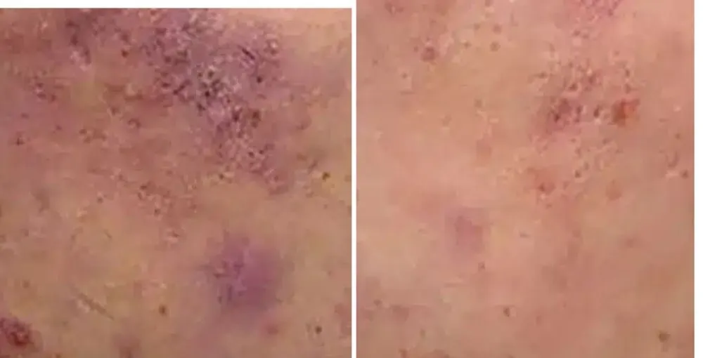 Active Acne Treatment before and after: the same person before treatment on the left and after treatment on the right, case 2. Results may vary.