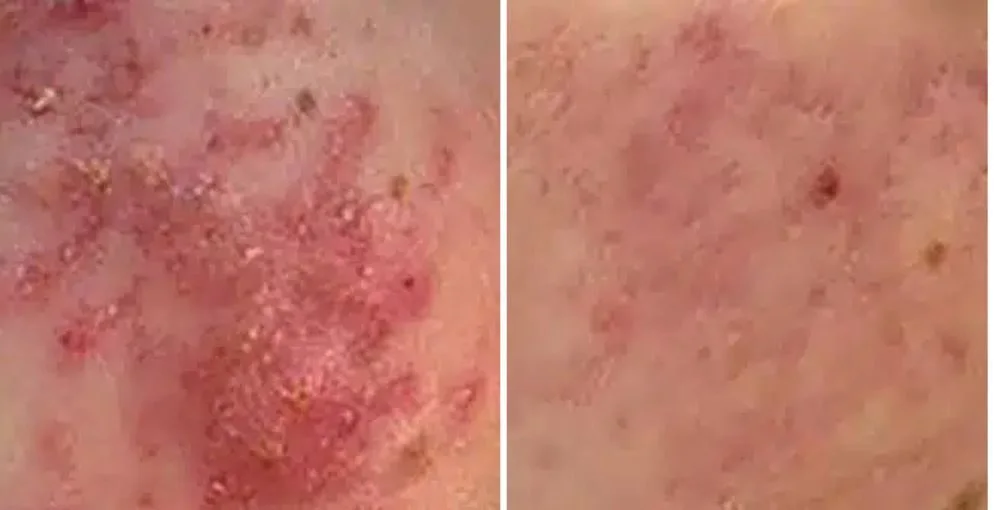 Active Acne Treatment before and after, enlarged: the same person before treatment on the left and after treatment on the right, case 3. Results may vary.