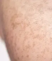 Close-up of freckles across a cheek and jawline before BBL HEROic pigment treatment in Southlake, TX
