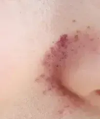 Close-up of persistent redness across the side of the nose and cheek, a concern treated with BBL HEROic in Southlake, TX