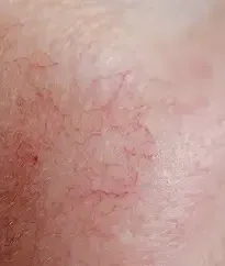 Close-up of small visible facial veins and telangiectasias treated with BBL HEROic in Southlake, TX