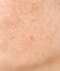 Close-up of sun spots and sun-damaged skin on a cheek, a concern treated with BBL HEROic in Southlake, TX