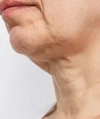Close-up of a neck and jawline showing loss of tone and elasticity, a concern treated with BBL HEROic at Medrein Health in Southlake, TX