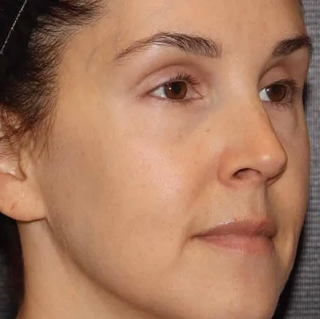 The same three-quarter view after BBL HEROic, with the dark cheek spot cleared and the freckling faded