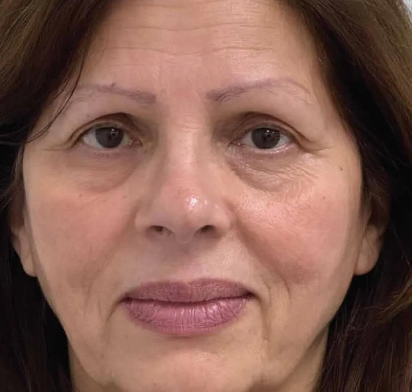 The same front view after BBL HEROic, with brighter, more even tone across the cheeks and forehead