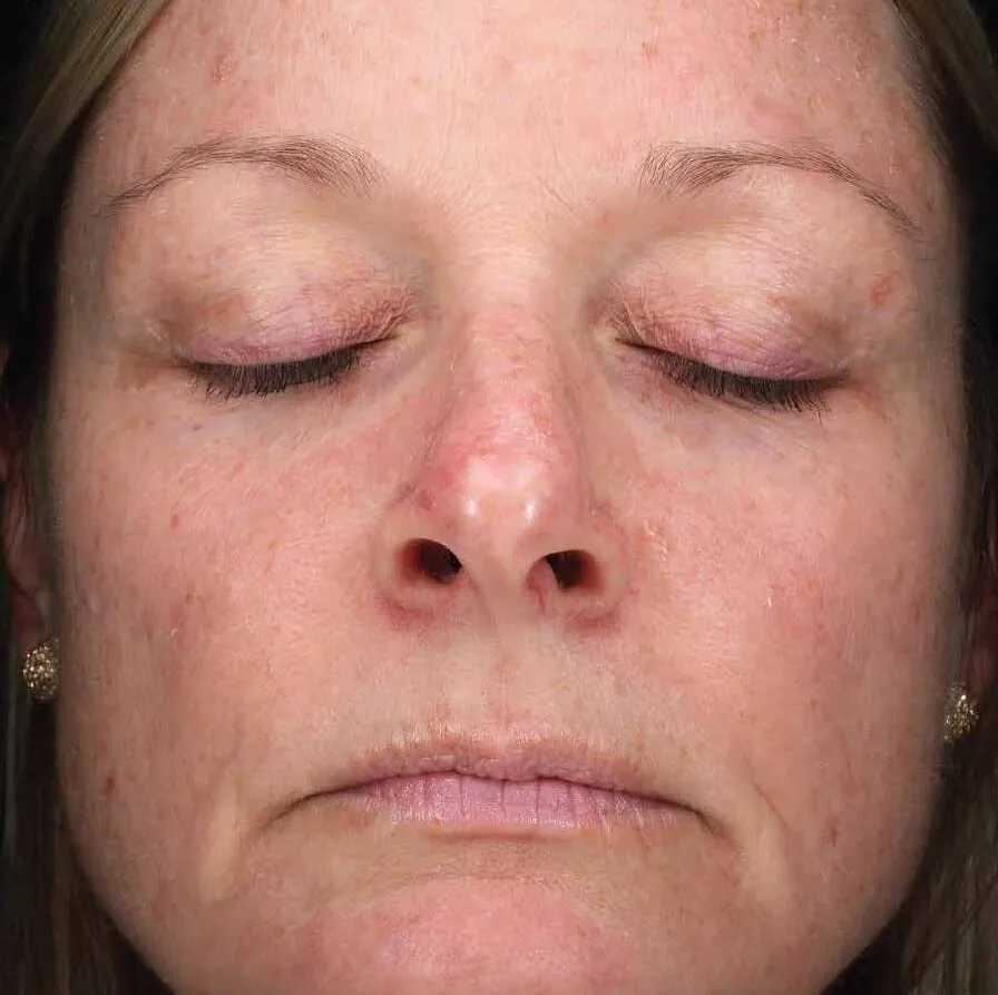 Lower face of a woman before BBL HEROic, showing redness over the nose and cheeks with scattered small brown spots