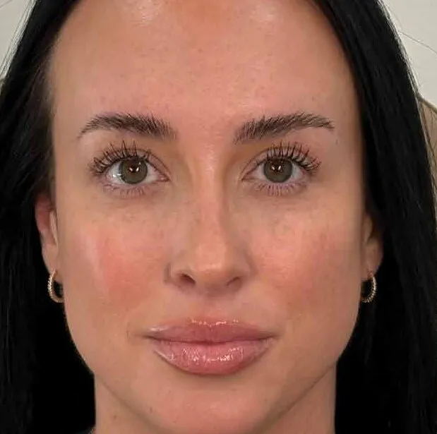 The same front view after BBL HEROic, with the freckling lightened and the flushing reduced