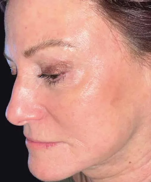 The same side profile after BBL HEROic, with the brown spots along the cheek and temple much reduced