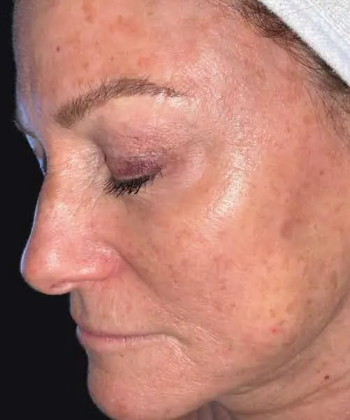 Side profile of a woman before BBL HEROic, showing sun damage as brown spots along the cheek and temple