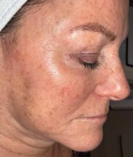 Three-quarter view of a woman before BBL HEROic, showing dense sun spots over the cheek and along the jawline