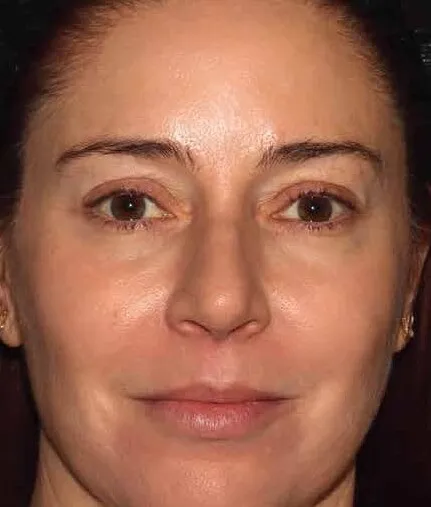 The same front view after BBL HEROic, with the under-eye and perioral pigment evened out and the skin brighter