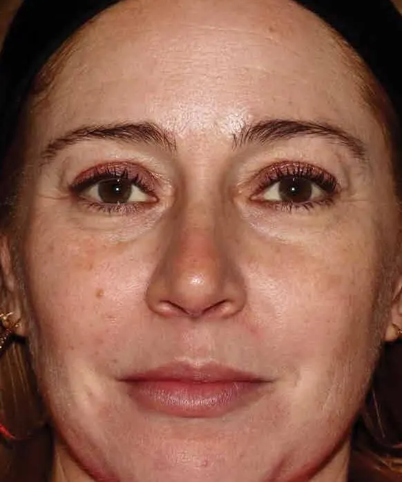 Front view of a woman before BBL HEROic, showing uneven tone with pigment under the eyes and around the mouth
