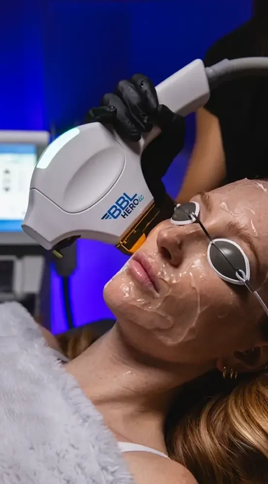 A Sciton BBL HEROic handpiece passing over a patient's gel-covered face, with shielded eyewear in place, during a treatment in Southlake, TX