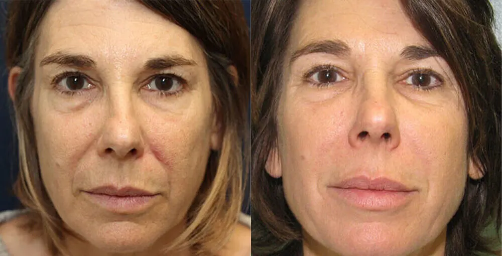 Bellafill before and after: the same person before treatment on the left and after treatment on the right, case 1. Results may vary.