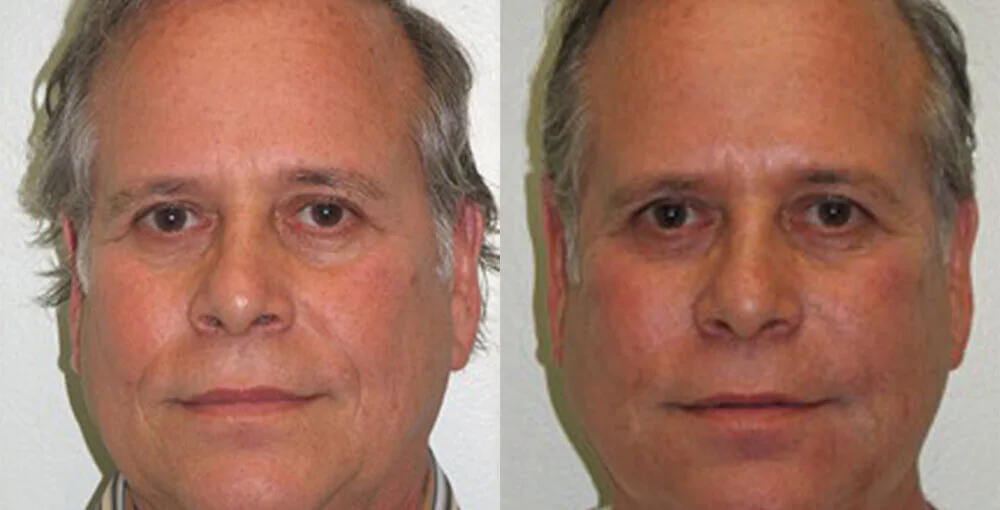 Bellafill before and after, enlarged: the same person before treatment on the left and after treatment on the right, case 2. Results may vary.