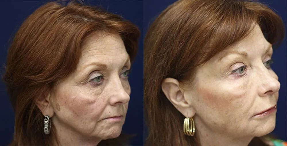 Bellafill before and after: the same person before treatment on the left and after treatment on the right, case 4. Results may vary.