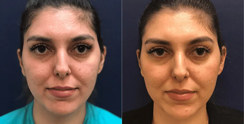 Bellafill before and after: the same person before treatment on the left and after treatment on the right, case 5. Results may vary.