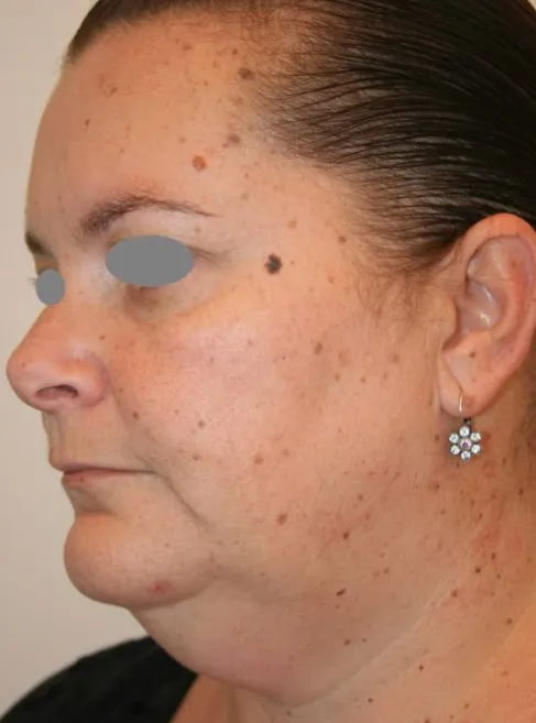 Three-quarter view of a woman’s face before benign lesion removal, showing raised moles and brown lesions over the cheek, jaw and neck