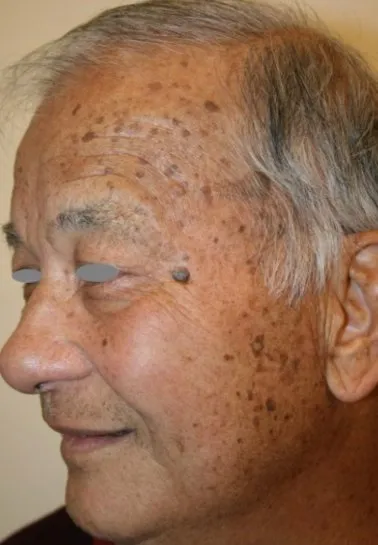 Three-quarter view of an older man’s face before benign lesion removal, showing raised brown lesions across the temple, brow and upper cheek