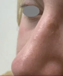 The same close-up after benign lesion removal, with the lesion gone and the skin flat