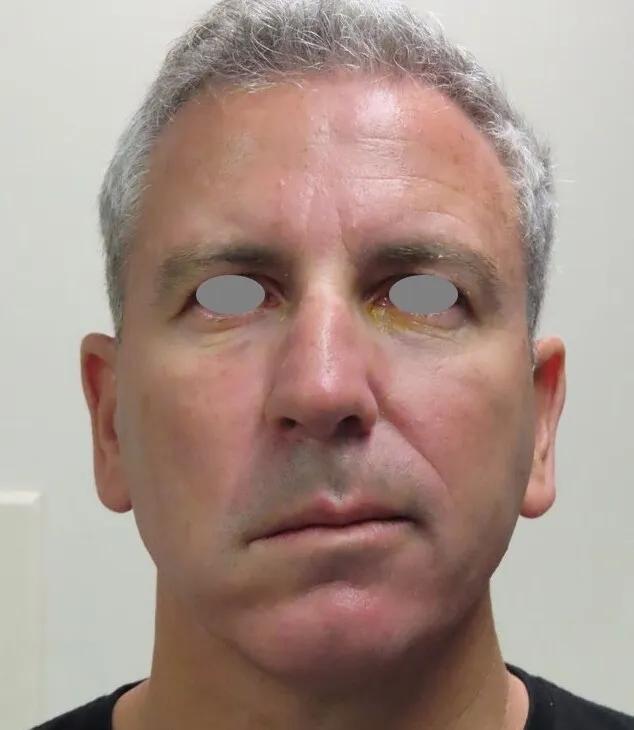 Front view of a man’s face after surgery, with bruising under both eyes and swelling gathered through the lower face