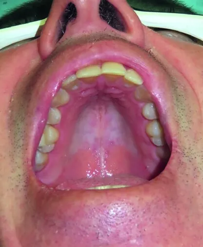 The same view of the roof of the mouth once healed, the tissue closed and an even pink throughout