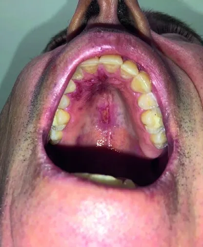 View of the roof of the mouth showing a raw surgical wound running back from behind the front teeth, inflamed at its edges