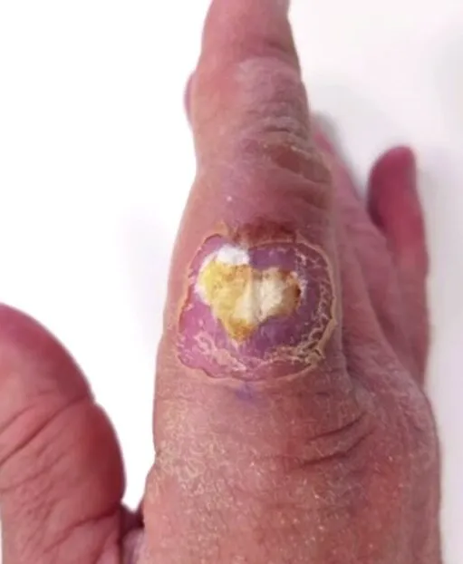 Close view of the back of a finger with an open wound, its base sloughy and the skin around it discoloured