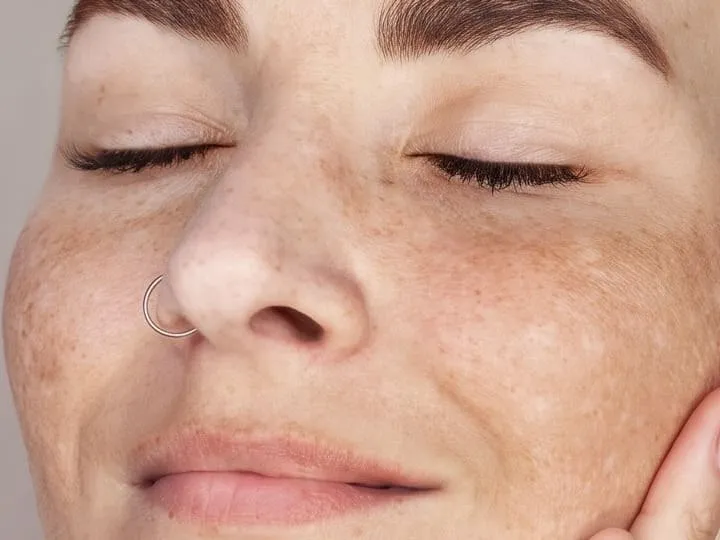 Freckling and soft brown melasma patches spread across both of a woman’s cheeks and the bridge of her nose, her eyes closed