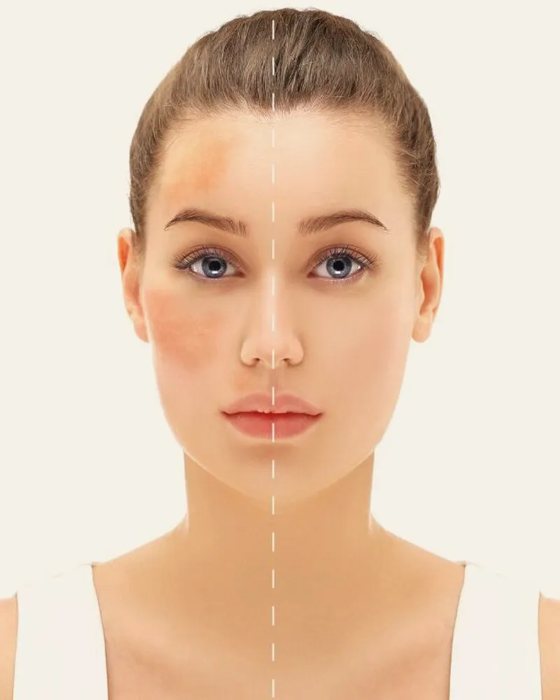 A woman shown from the shoulders up, her face split down the middle — uneven blotchy tone across one cheek against even tone on the other, illustrating what melasma looks like