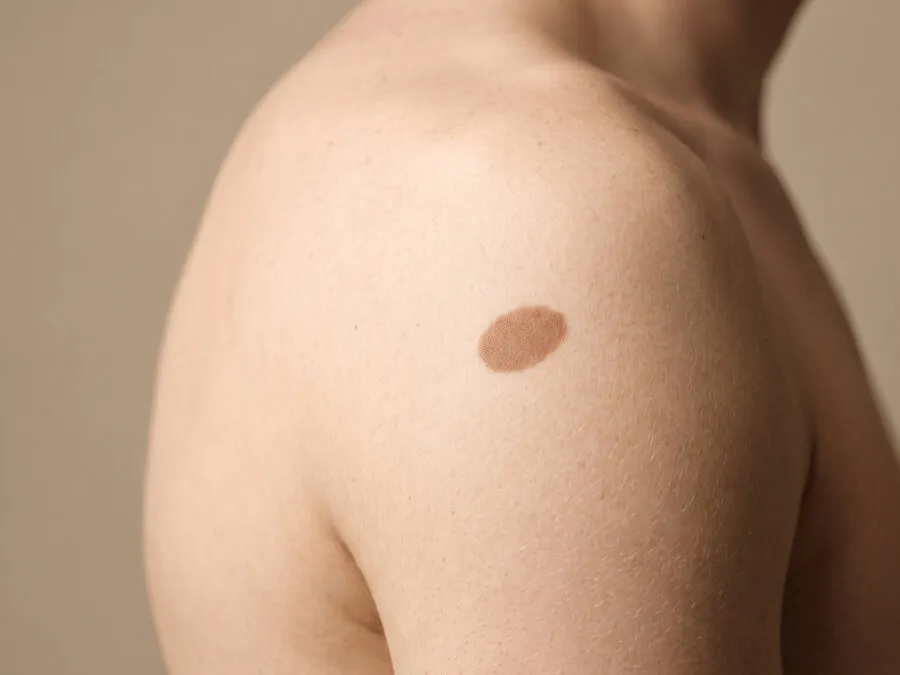 A defined flat oval brown birthmark on a man’s bare shoulder and upper arm