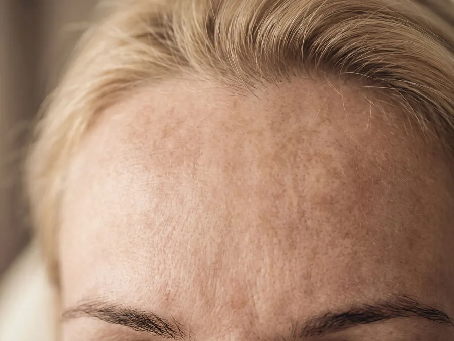 Mottled, uneven overall skin tone across a woman’s forehead