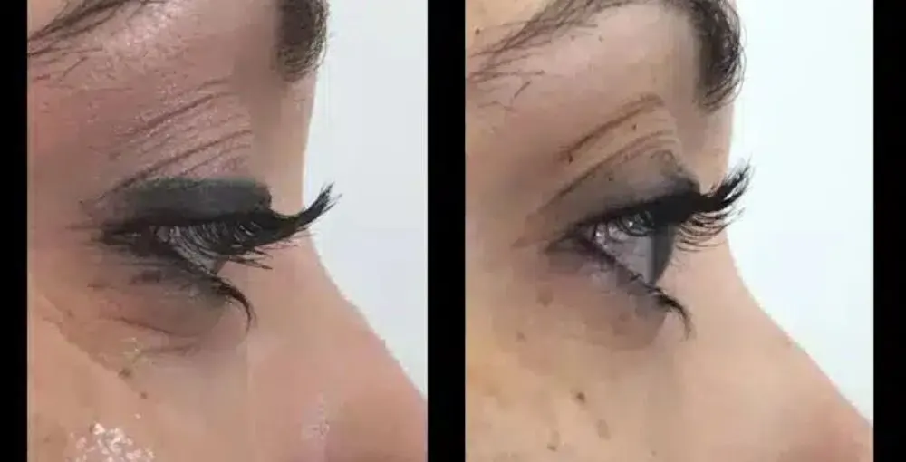 Eyelase before and after: the same person before treatment on the left and after treatment on the right, case 1. Results may vary.