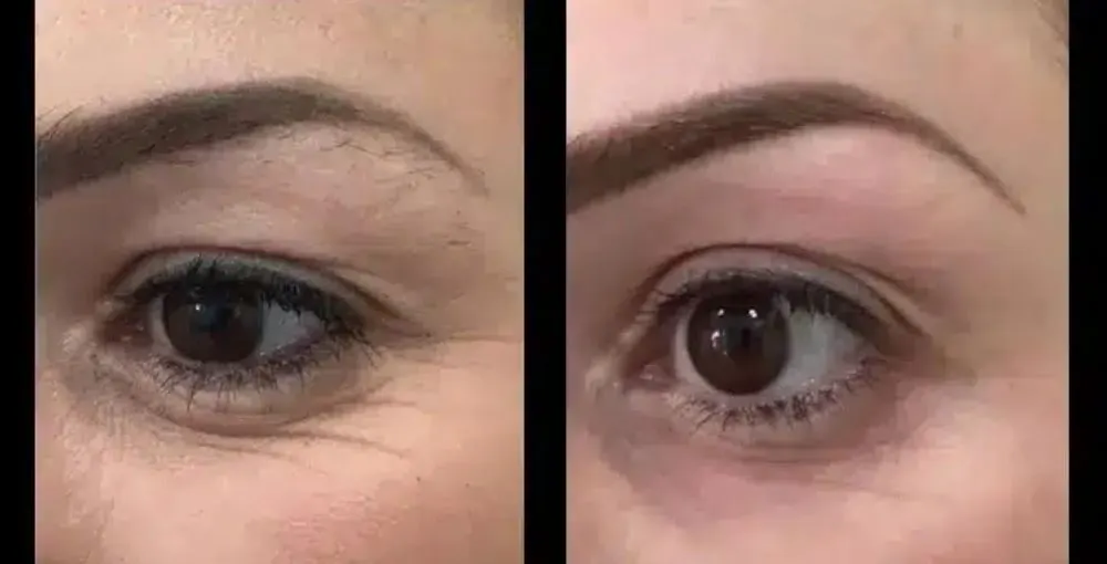 Eyelase before and after: the same person before treatment on the left and after treatment on the right, case 2. Results may vary.