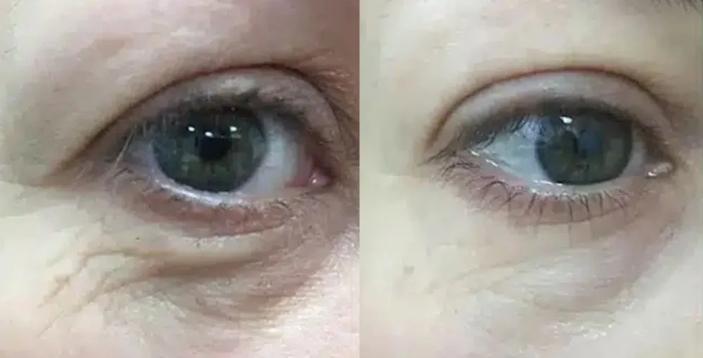 Eyelase before and after, enlarged: the same person before treatment on the left and after treatment on the right, case 3. Results may vary.