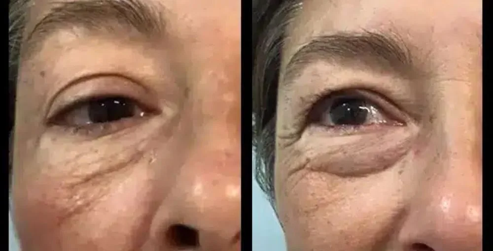 Eyelase before and after, enlarged: the same person before treatment on the left and after treatment on the right, case 4. Results may vary.
