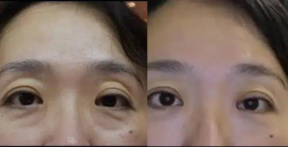 Eyelase before and after: the same person before treatment on the left and after treatment on the right, case 5. Results may vary.