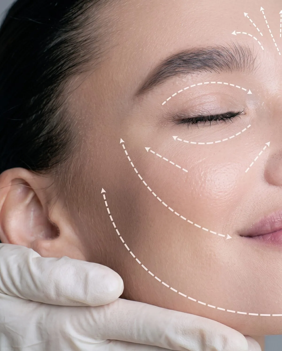 Close view of a woman's cheek and closed eye with dashed arrows drawn upward along the jaw, cheek and brow, showing the direction of lift a Fotona 4D facelift aims for, a gloved hand supporting her jaw