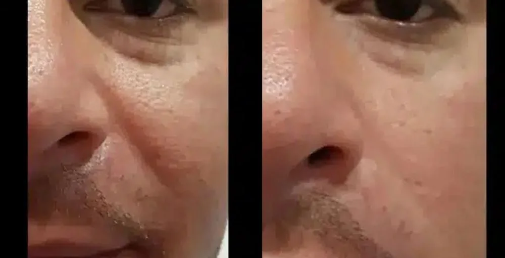 Fotona 4D Facelift before and after, enlarged: the same person before treatment on the left and after treatment on the right, case 1. Results may vary.