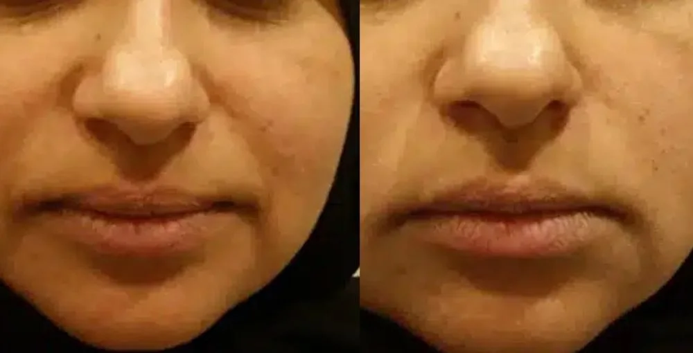 Fotona 4D Facelift before and after, enlarged: the same person before treatment on the left and after treatment on the right, case 2. Results may vary.