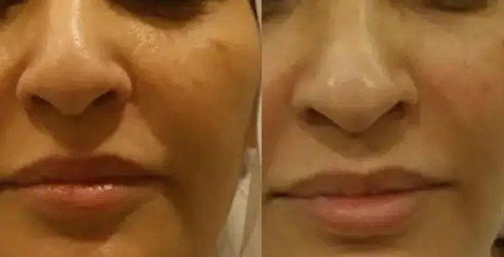 Fotona 4D Facelift before and after, enlarged: the same person before treatment on the left and after treatment on the right, case 3. Results may vary.