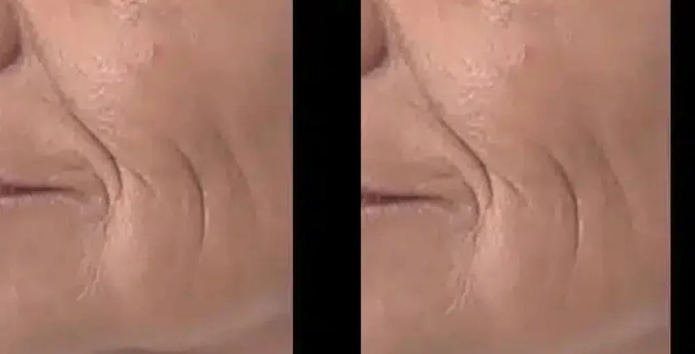 Fotona 4D Facelift before and after, enlarged: the same person before treatment on the left and after treatment on the right, case 4. Results may vary.