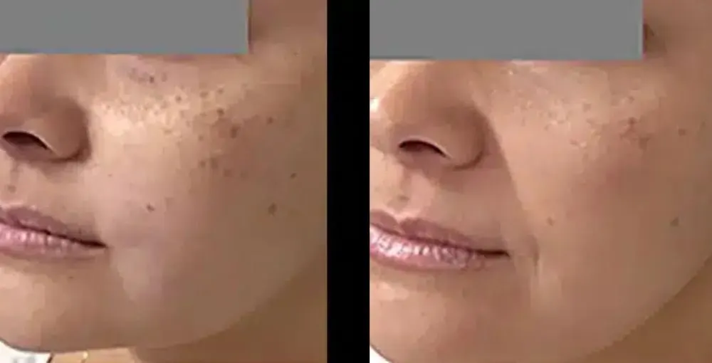 Fotona 4D Facelift before and after: the same person before treatment on the left and after treatment on the right, case 5. Results may vary.