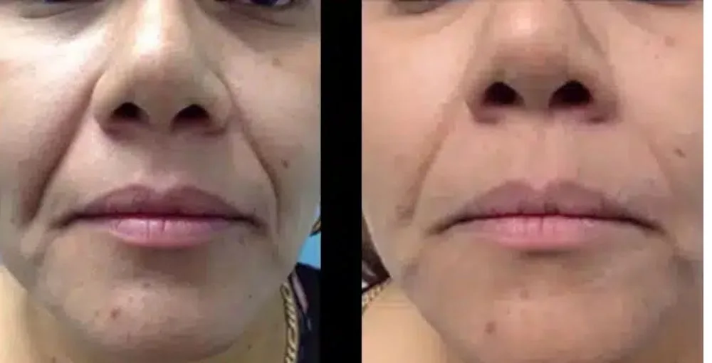 Fotona 4D Facelift before and after, enlarged: the same person before treatment on the left and after treatment on the right, case 6. Results may vary.